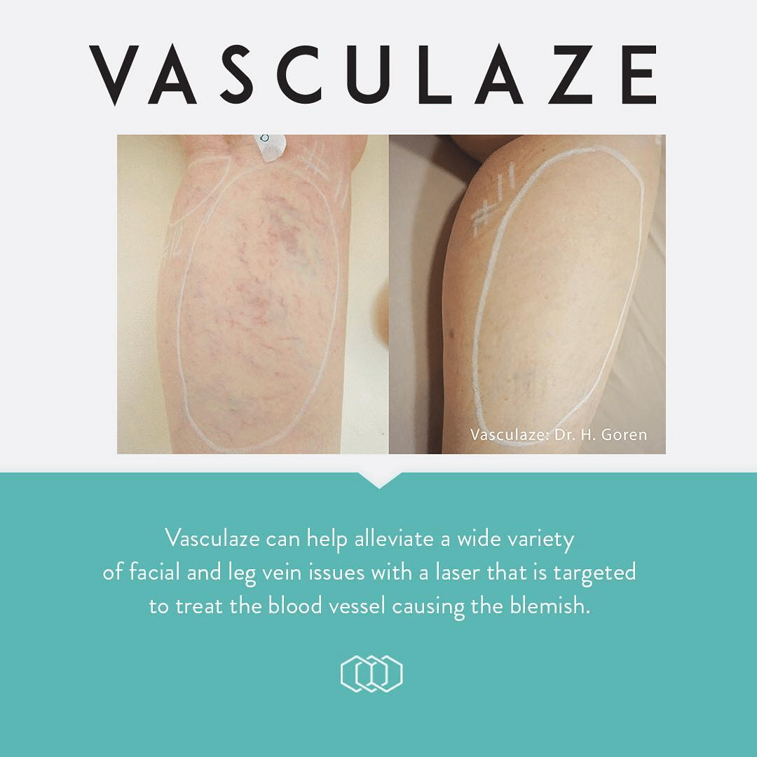 Vasculaze